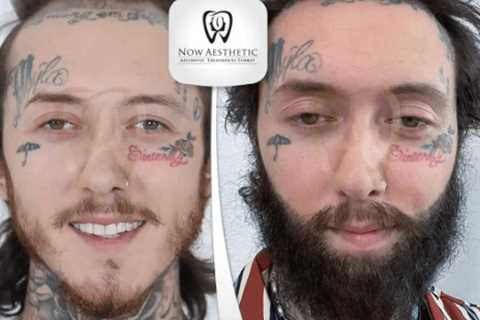 Beard Transplant in Turkey, Istanbul