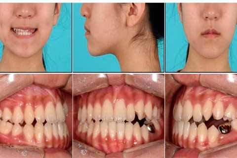 The Role of Bicuspids in Chewing Food