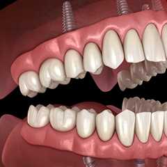 What is the Average Cost of a Dental Implant Procedure in Orange County?