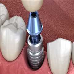 What is the Cost of Dental Implants in Nashville, TN?