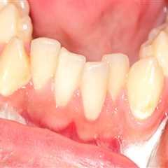 When Your Bicuspids Strike: Handling A Dental Emergency In San Diego