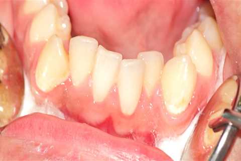 When Your Bicuspids Strike: Handling A Dental Emergency In San Diego