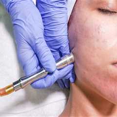 What Clinical Research Organizations Can Teach Us About Better Microdermabrasion in Zurich
