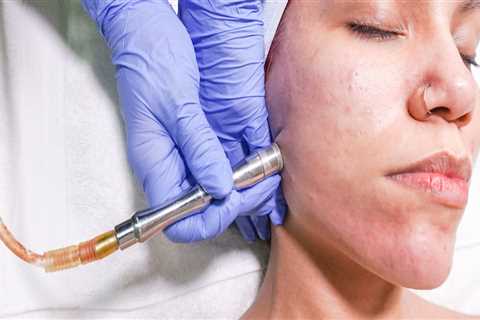 What Clinical Research Organizations Can Teach Us About Better Microdermabrasion in Zurich