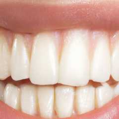 Understanding Bicuspids in Teeth Whitening in Ottawa